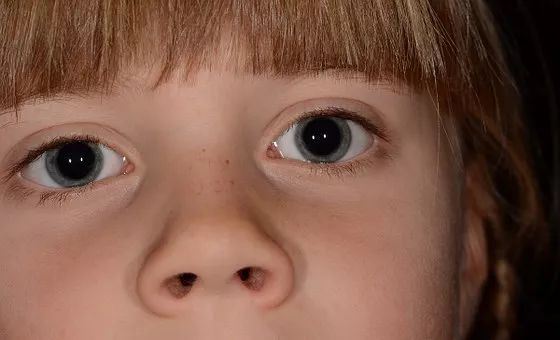 8岁男童挖鼻孔竟致颅内感染!医生:脑神经已受损图1