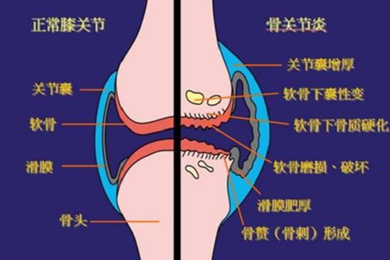 正常膝关节与患有骨关节炎的膝关节