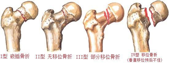 股骨颈骨折的类型