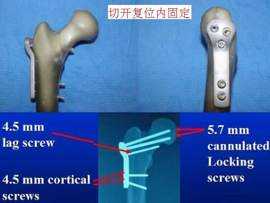 股骨颈的切开复位内固定