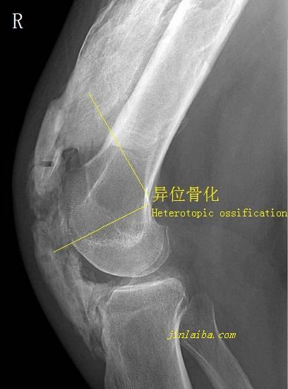 肘关节处的异位骨化