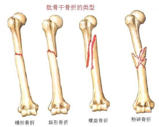 肱骨干骨折术后康复方案图1