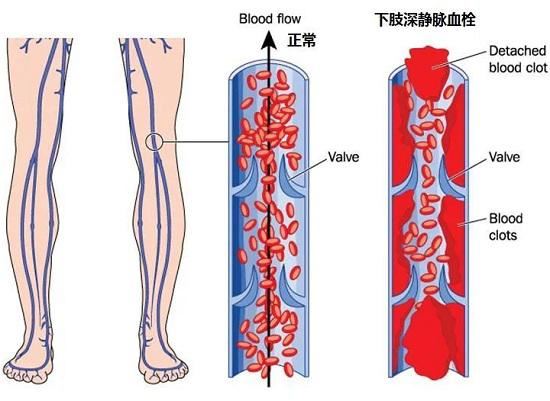 静脉血栓