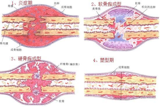 骨折的愈合过程