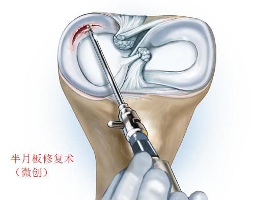 半月板半节镜修复示意图