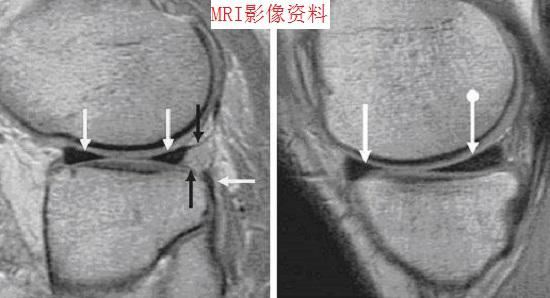 膝关节的MRI资料