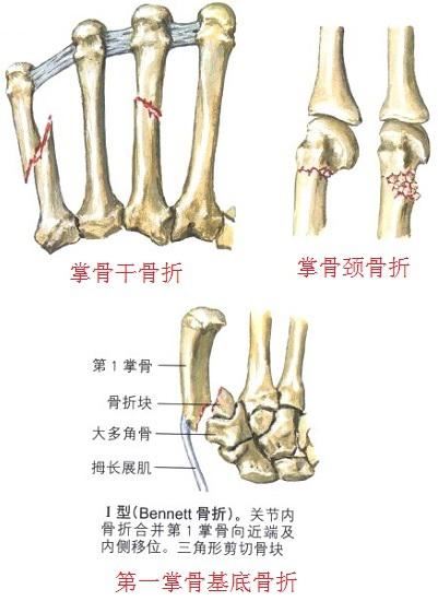 某些类型的掌骨骨折