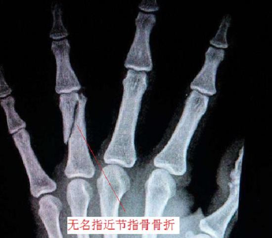指骨骨折 指骨骨折