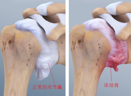 关节囊挛缩引发“冻结肩”（肩周炎）