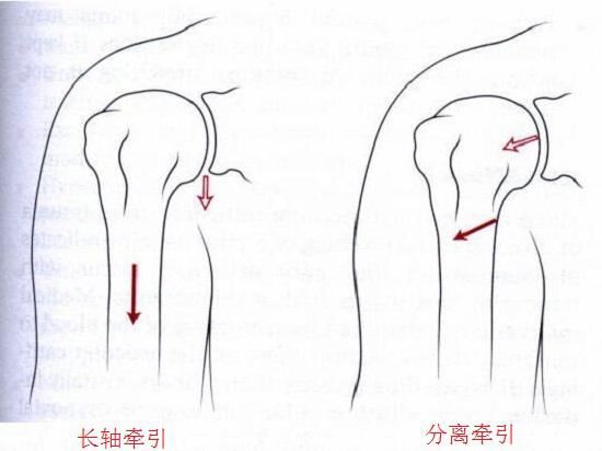 肩关节的长轴牵引和分离牵引