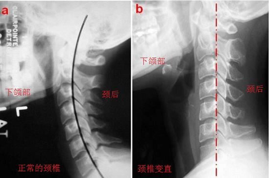 颈椎的生理曲度变化