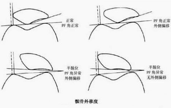 髌骨与股骨滑车的相对位置