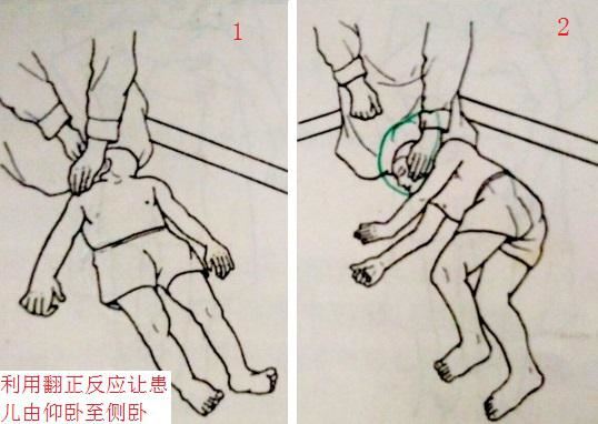 利用翻正反应让患儿由仰卧至侧卧