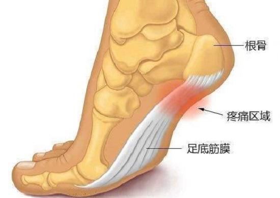 足底筋膜炎