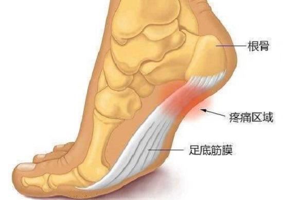 足底筋膜炎：你必须要明白的几个事实(陈冠希患艾滋病)图1