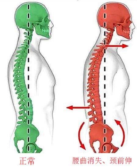 正常的脊柱与腰曲消失后的脊柱