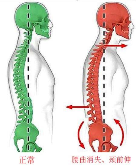 为什么不建议腰椎病患者盲目练习“小燕飞”(相宜本草祛痘图1