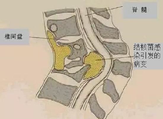 腰椎结核病