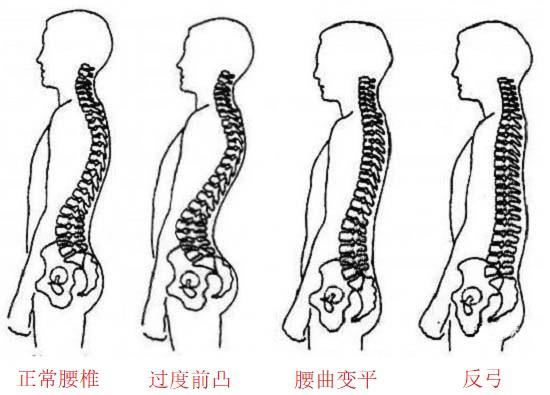 不同姿态的腰椎