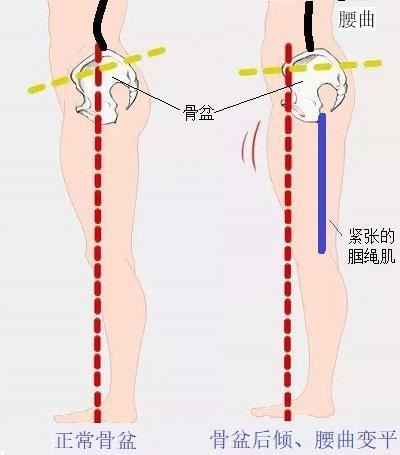 腘绳肌与腰椎曲度的关系