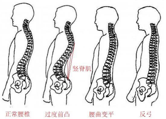 竖脊肌与腰椎的关系