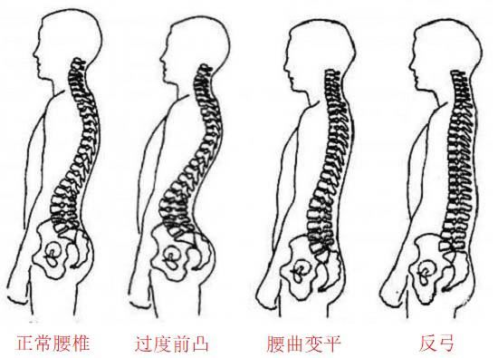 不同的腰椎曲度