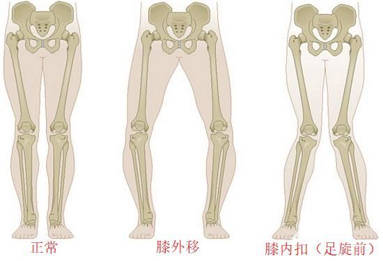 畸形的踝、膝、髋关节