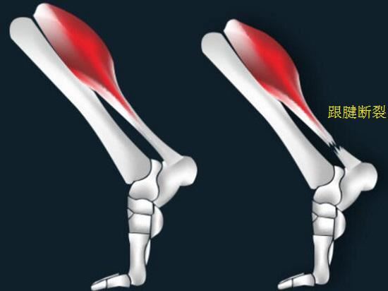 小腿三头肌离心功能弱造成跟腱断裂