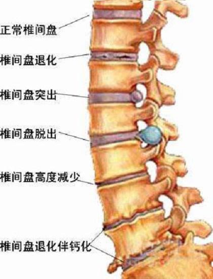 退变的椎间盘和脊柱