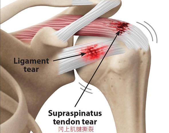 肩袖损伤