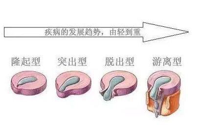 腰椎间盘突出诱发疼痛的原因及应对方法(掌掴张韶涵)图1