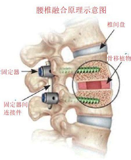 腰椎融合术原理示意图