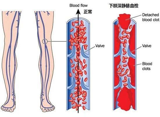 下肢静脉血栓的形成机制
