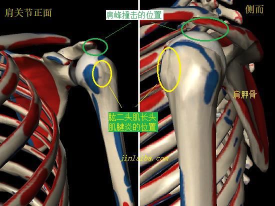 肩峰撞击和肱二头肌长头肌腱炎的位置