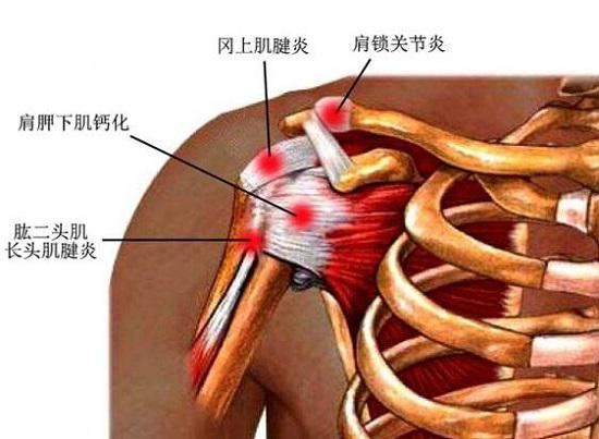 肱二头肌长头肌腱炎