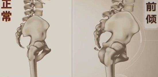 骨盆前倾、腰椎曲度变大的改善思路(人中长痘)图1