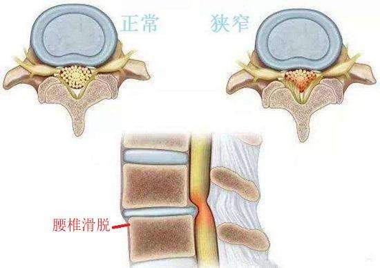 腰椎滑脱和椎间盘突出引发的椎管狭窄