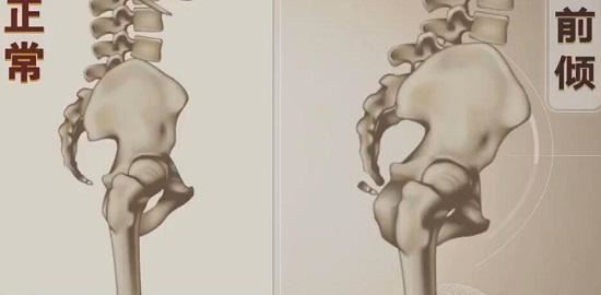 骨盆前倾、腰椎曲度变大的改善思路图1