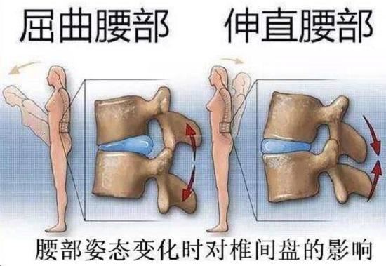 腰椎姿态变化对椎间盘的影响