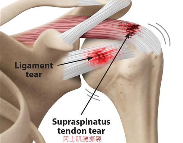 肩袖损伤保守治疗过程中的康复训练图1