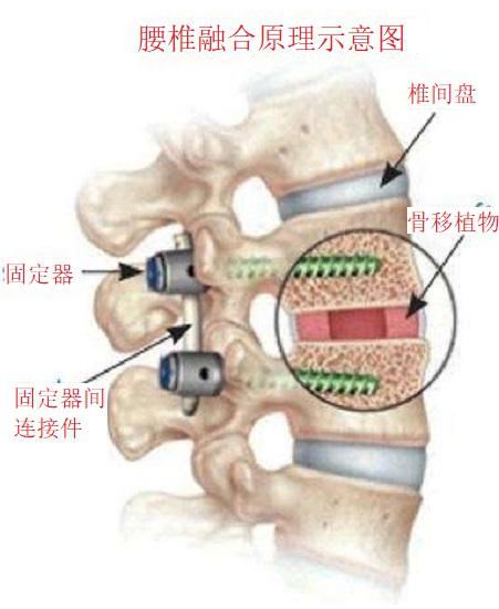 腰椎融合术的适应证图1