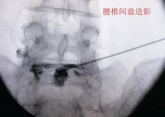 腰椎间盘造影 腰椎间盘造影