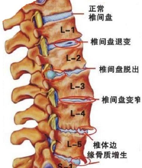 腰椎骨质增生