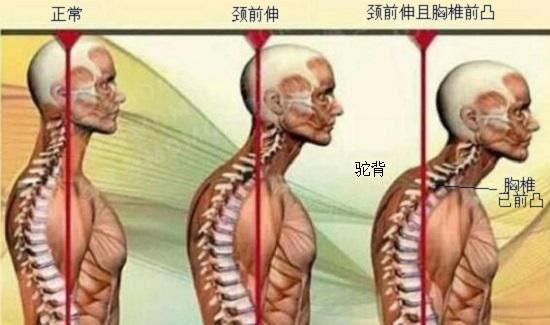 肩、颈、背部的畸变和功能障碍