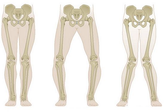 不几类型的膝关节力线紊乱