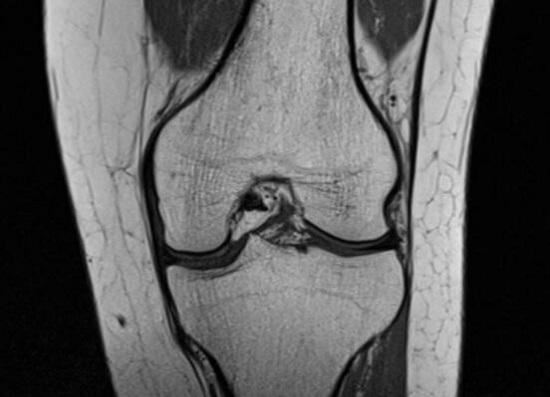膝关节影像资料