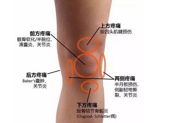 深蹲的弊端：给膝关节疼痛者的几条建议图1